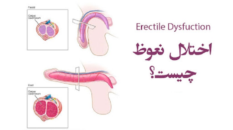 اختلال نعوظ