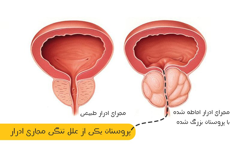 پروستات یکی از علل تنگی مجرای ادرار