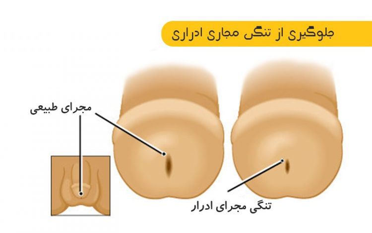 تنگی نوک مجرای ادرار