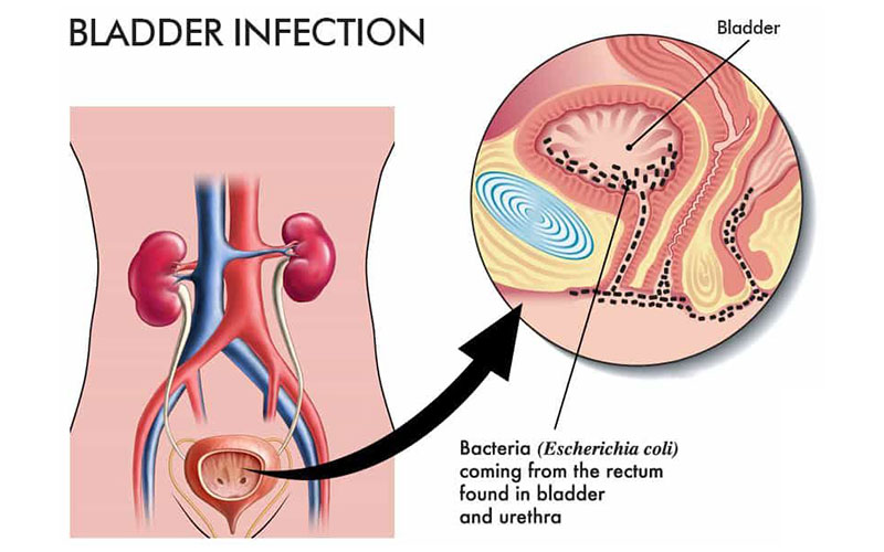 عفونت مثانه
